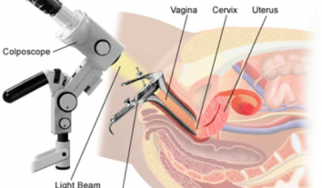 Colposcopy