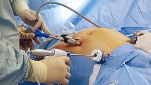 Laparoscopy Center In Beed